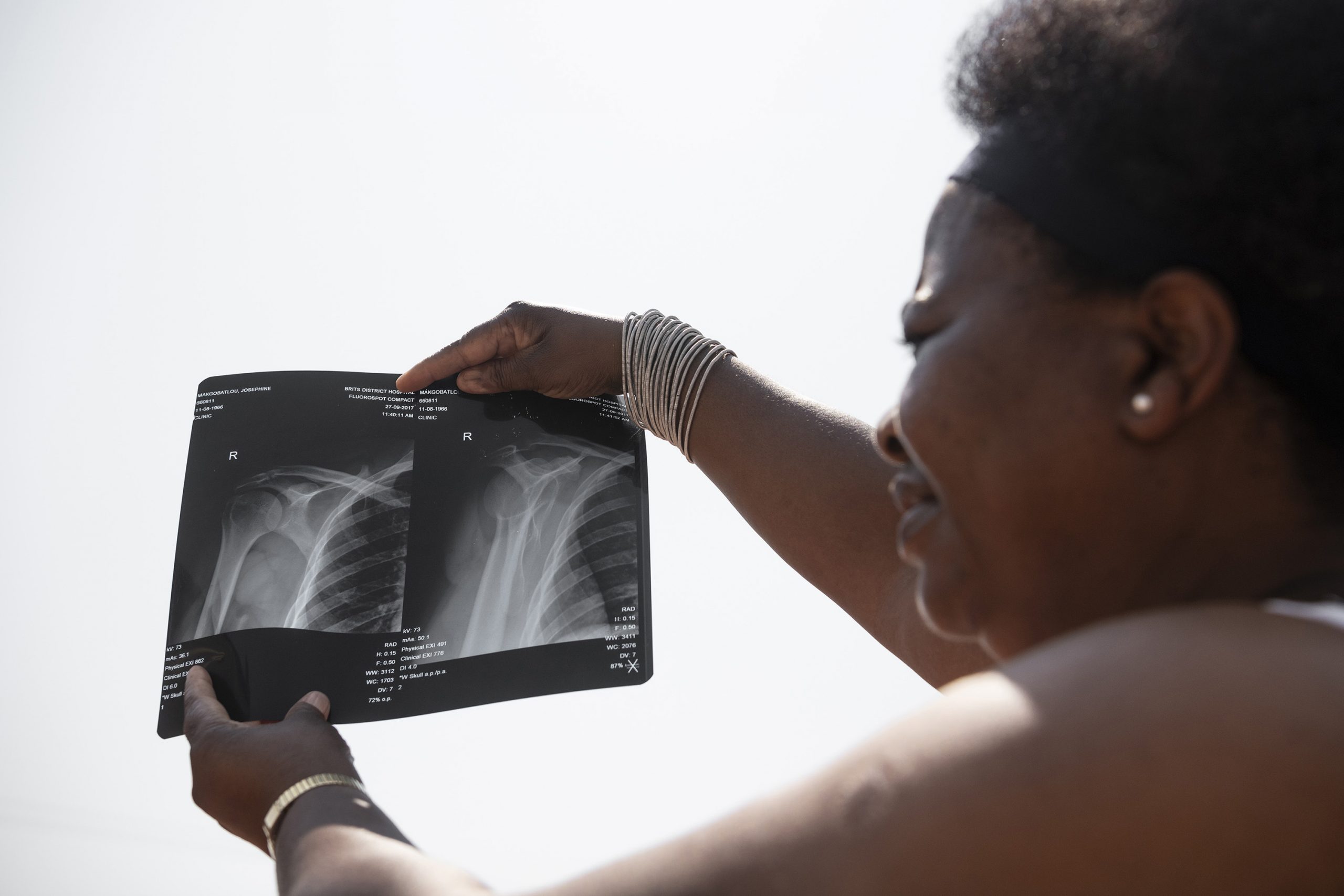 23 September 2019: Poppy Makgobatlou with X-rays of her shoulder showing the injuries she sustained when her former husband beat her. 