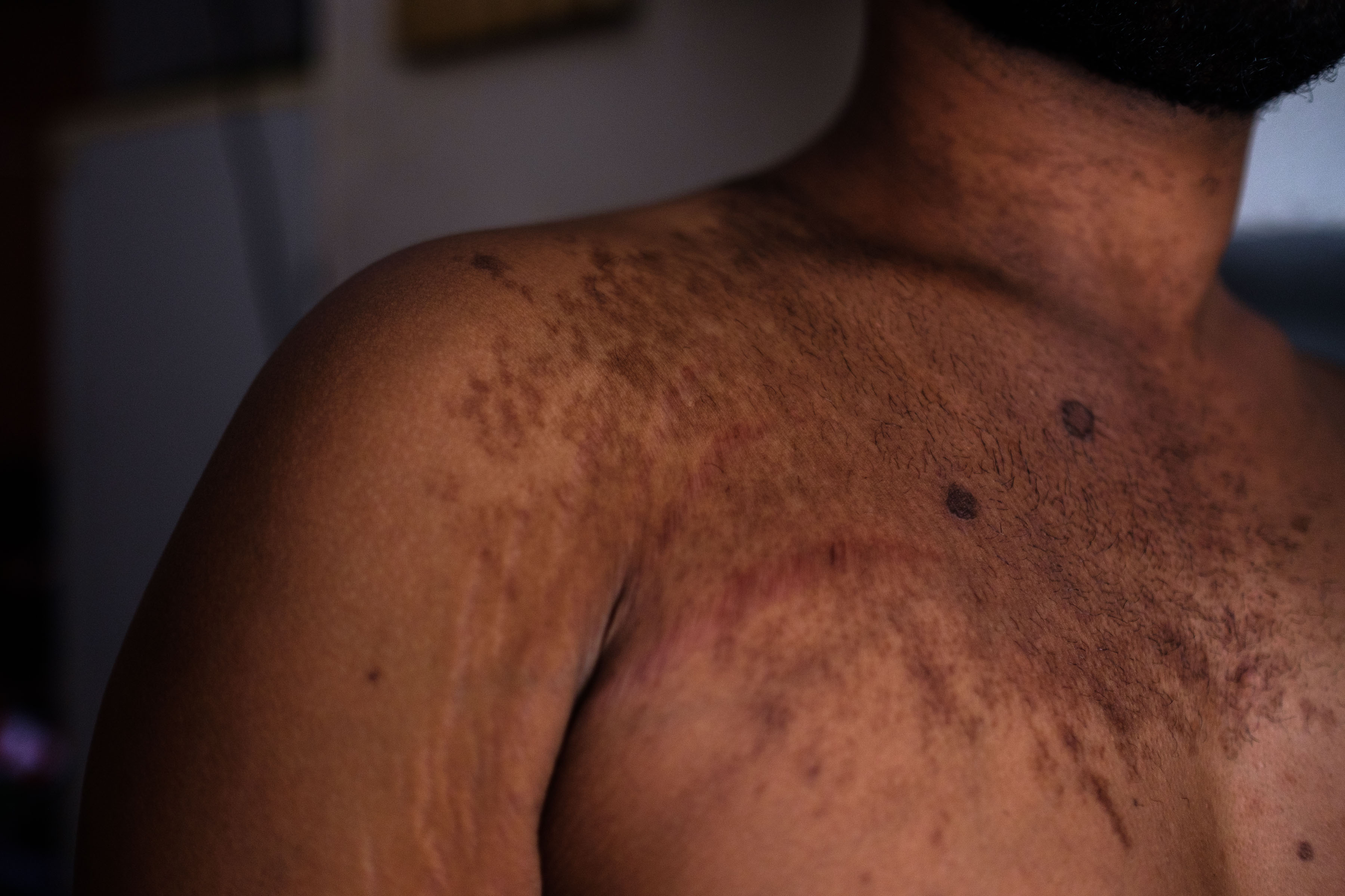 9 December 2019: Ishmael has been assaulted more than 20 times since arriving in South Africa and his father tried to have him killed multiple times before that. The scars on his chest are from past assaults.