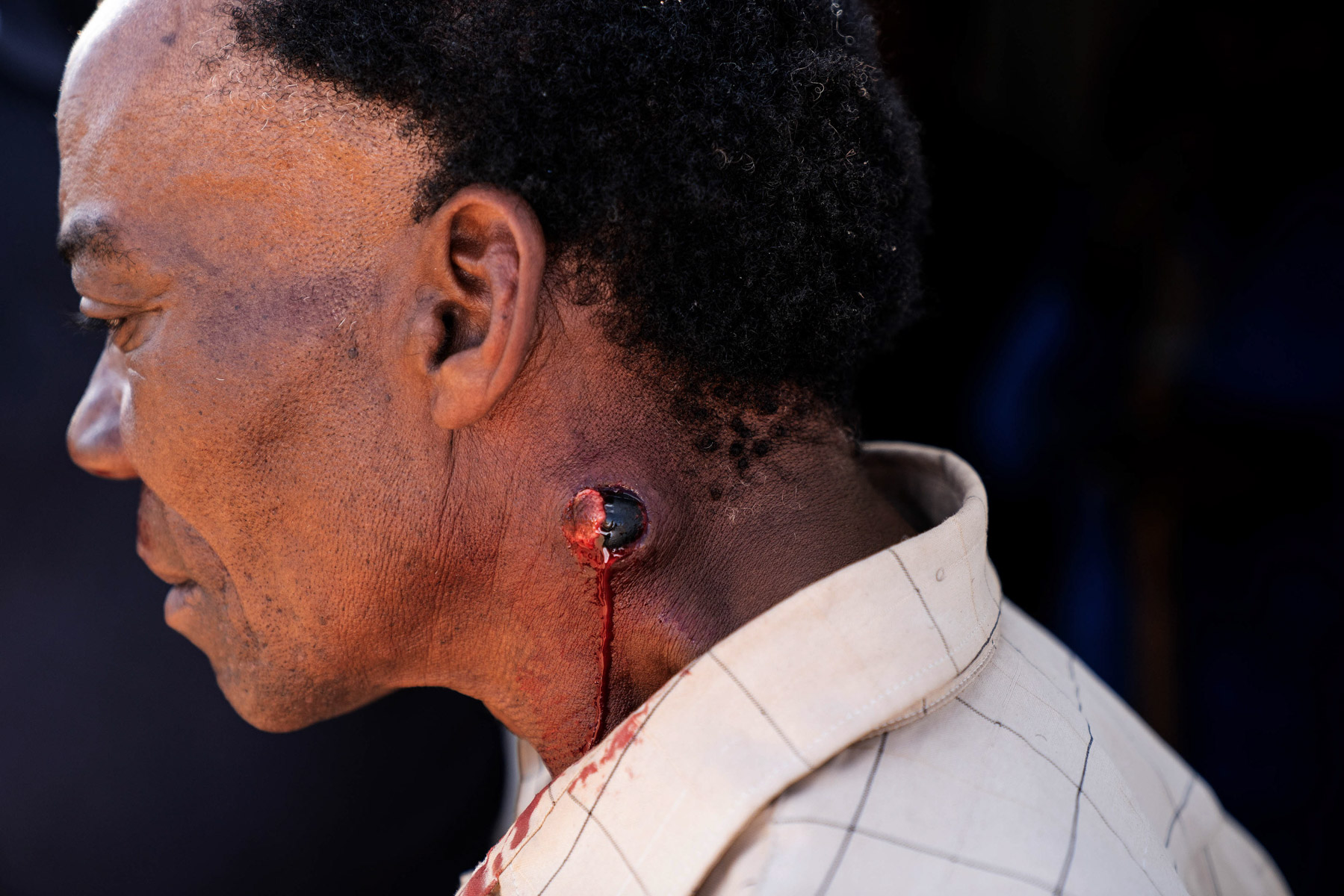 21 April 2020: A metro police officer shot Stanley Zaki in the neck at close range with a rubber bullet, which lodged in his flesh. (Photograph by James Oatway)